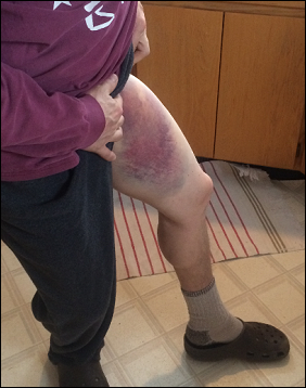 Ski Bum Poet's Thigh Hematoma